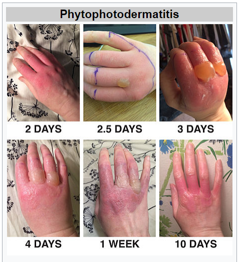 Phytophotodermatitis.PNG