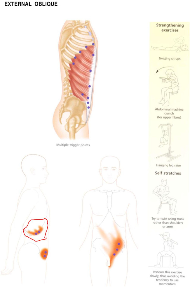 Triggerkirjan sivulta 84 external oblique kyljen pisteet.JPG