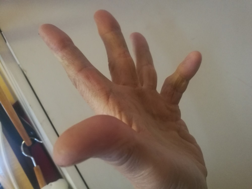 392019143851.jpg (189.19 KiB) Katsottu 3981 kertaa Dupuytrenin kontaktura
